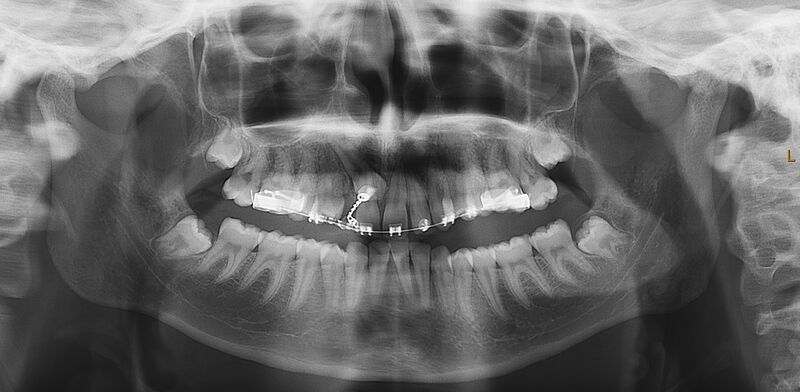 File:Impacted canine - treated with gold chain (Radiopaedia 86145).jpg