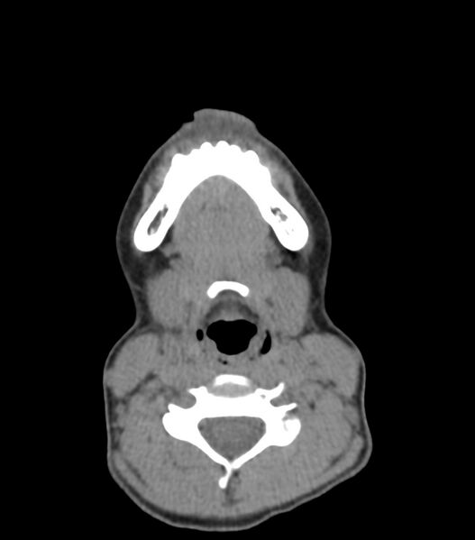 File:Nasoorbitoethmoid fracture (Radiopaedia 90044-107205 Axial non-contrast 43).jpg
