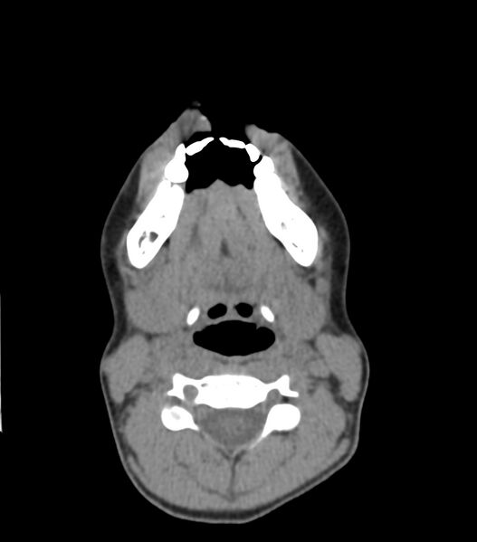 File:Nasoorbitoethmoid fracture (Radiopaedia 90044-107205 Axial non-contrast 55).jpg