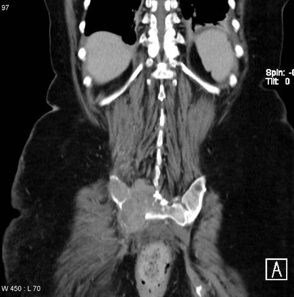 File:Nerve sheath tumor - malignant - sacrum (Radiopaedia 5219-6987 B 14).jpg
