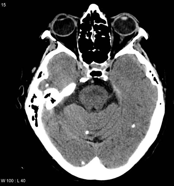 File:Neurocysticercosis (Radiopaedia 7773-8596 non-contrast 1).jpg