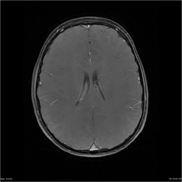 File:Neurofibromatosis type 1 (Radiopaedia 22541-22564 Axial T1 C+ fat sat 32).jpg