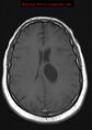 Neuroglial cyst (Radiopaedia 10713-11184 Axial T1 9).jpg