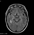 Neurosarcoidosis (Radiopaedia 10930-11351 Axial FLAIR 8).jpg