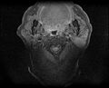 Non-Hodgkin lymphoma - parotid gland (Radiopaedia 71531-81890 T1 fat sat 12).jpg