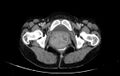 Non-puerperal uterine inversion (Radiopaedia 78343-91094 A 80).jpg