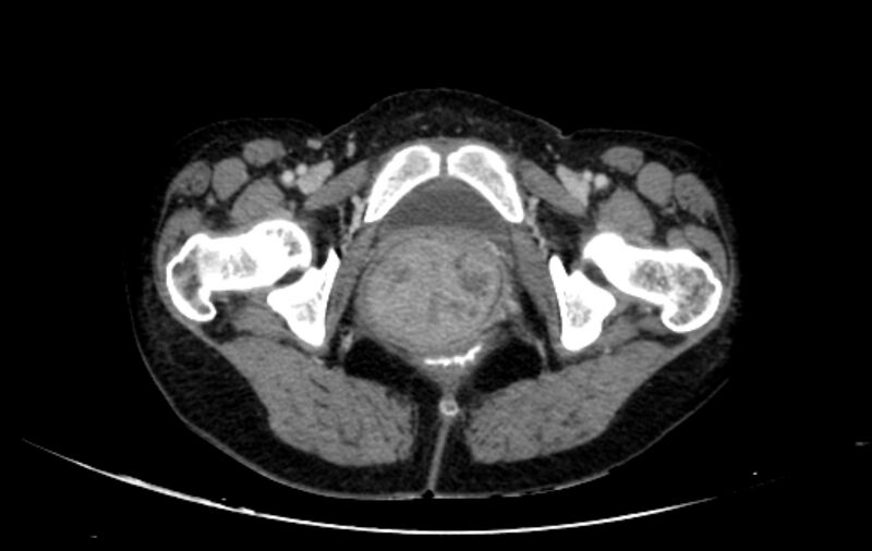 File:Non-puerperal uterine inversion (Radiopaedia 78343-91094 A 80).jpg