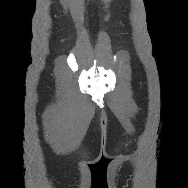 File:Normal CT angiogram of pelvis (Radiopaedia 45390-49430 B 43).jpg