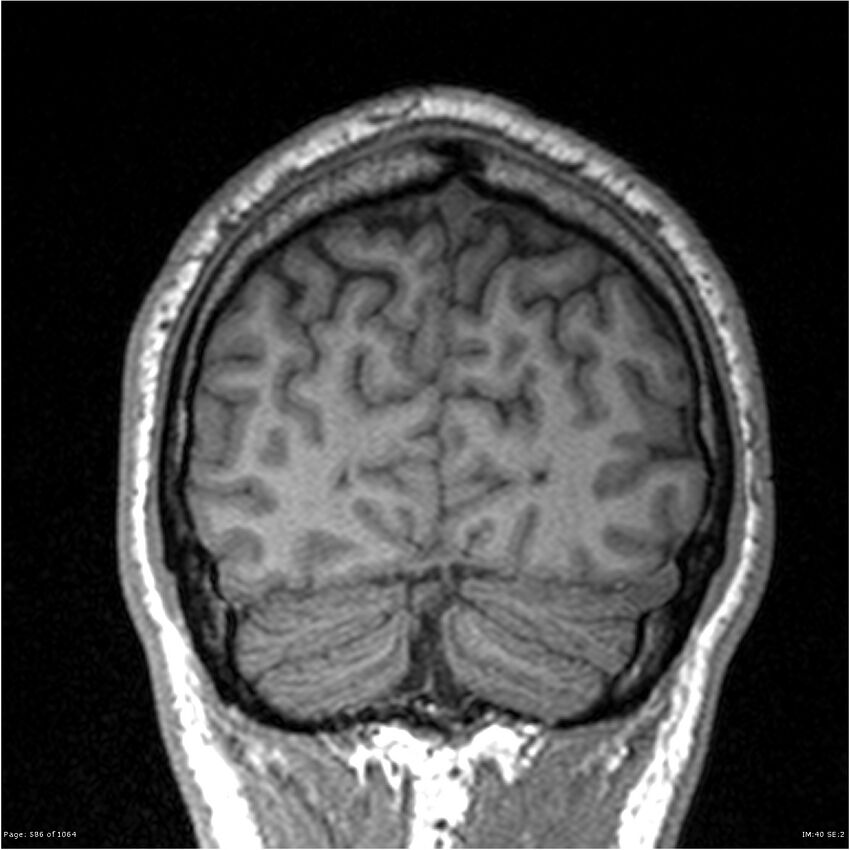 Normal brain MRI (non-focal epilepsy protocol) (Radiopaedia 38571-40700 Coronal T1 19).jpg