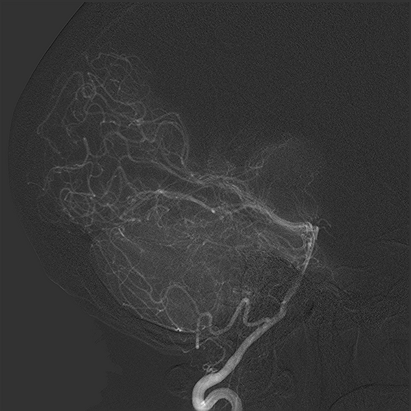 File:Normal cerebral angiogram (four vessel DSA) (Radiopaedia 41708-44649 L 11).png