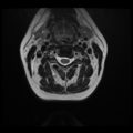 Normal cervical and thoracic spine MRI (Radiopaedia 35630-37156 Axial T2 23).png