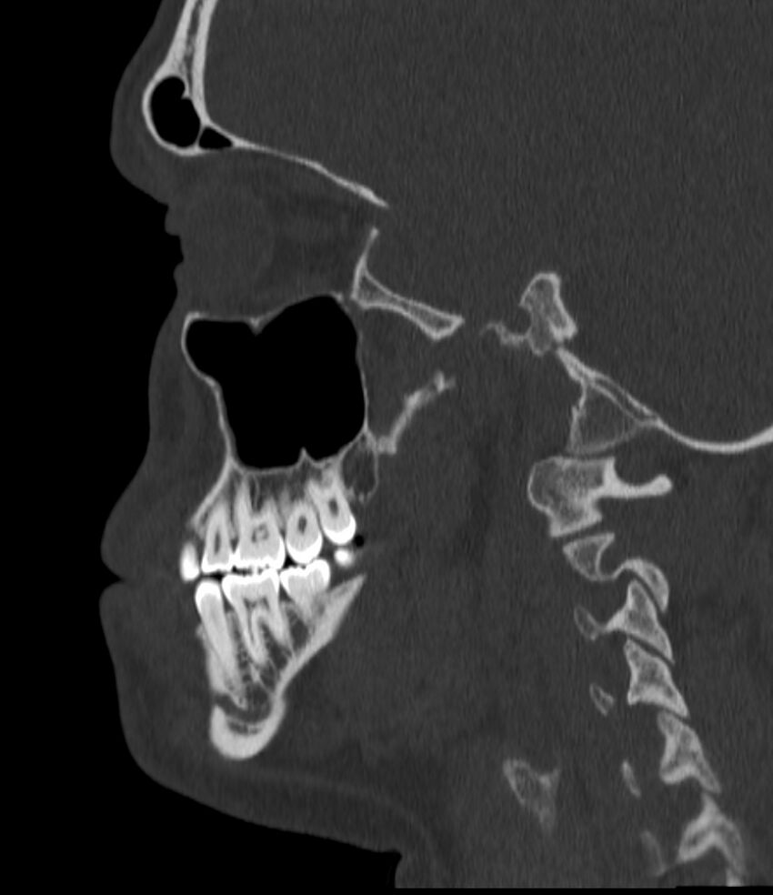 Normal facial bone CT (Radiopaedia 88742-105476 Sagittal bone window 110).jpg