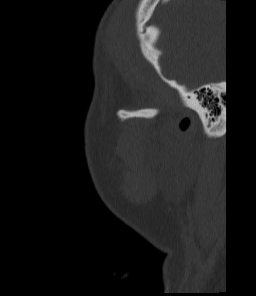 Normal facial bone CT (Radiopaedia 88742-105476 Sagittal bone window 151).jpg