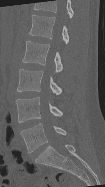 File:Normal lumbar spine CT (Radiopaedia 46533-50986 Sagittal bone window 47).png