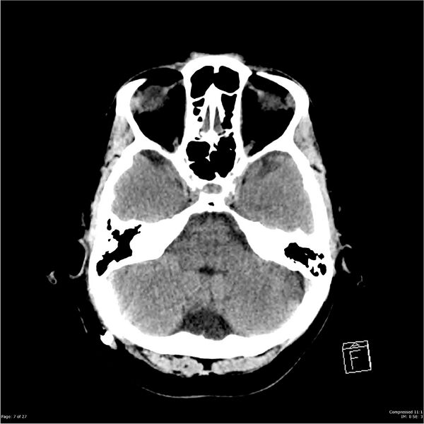 File:Normal pressure hydrocephalus (Radiopaedia 24415-24736 Axial non-contrast 4).jpg