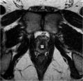 Normal prostate (MRI) (Radiopaedia 29986-30536 A 4).png
