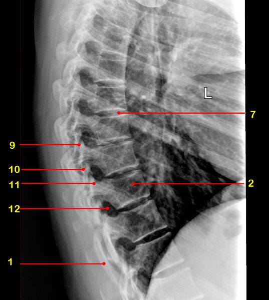 File:Normal radiographic anatomy of the thoracic spine (Radiopaedia 43007-46261 Lateral 1).jpg