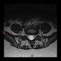 Normal spine MRI (Radiopaedia 77323-89408 Axial T2 23).jpg