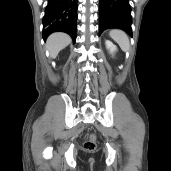 File:Obstructive bladder transitional cell carcinoma (Radiopaedia 9825-10410 B 24).jpg