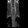 Occipital condyle fracture (Radiopaedia 31755-32691 Coronal bone window 15).jpg