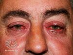 Ocular rosacea (DermNet NZ acne-ocular-rosacea).jpg