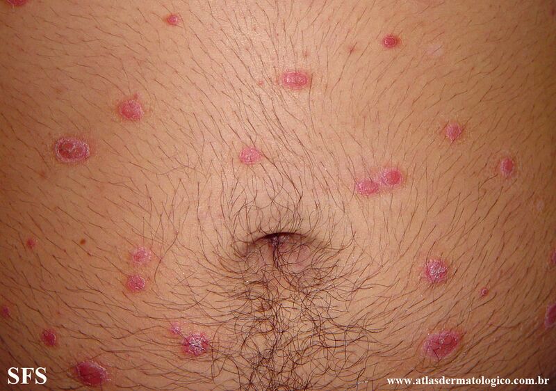File:Psoriasis (Dermatology Atlas 146).jpg