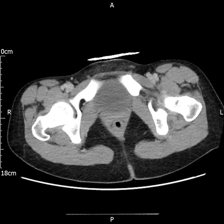 AAST grade IV kidney injury with CEUS follow-up (Radiopaedia 72353-82877 Axial C+ portal venous phase 78).jpg