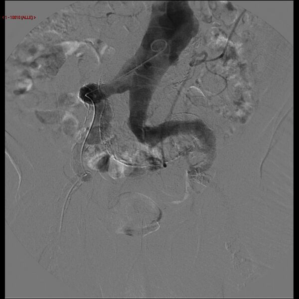 File:Abdominal aortic aneurysm (Radiopaedia 16155-15833 Frontal Aorta 6).jpg