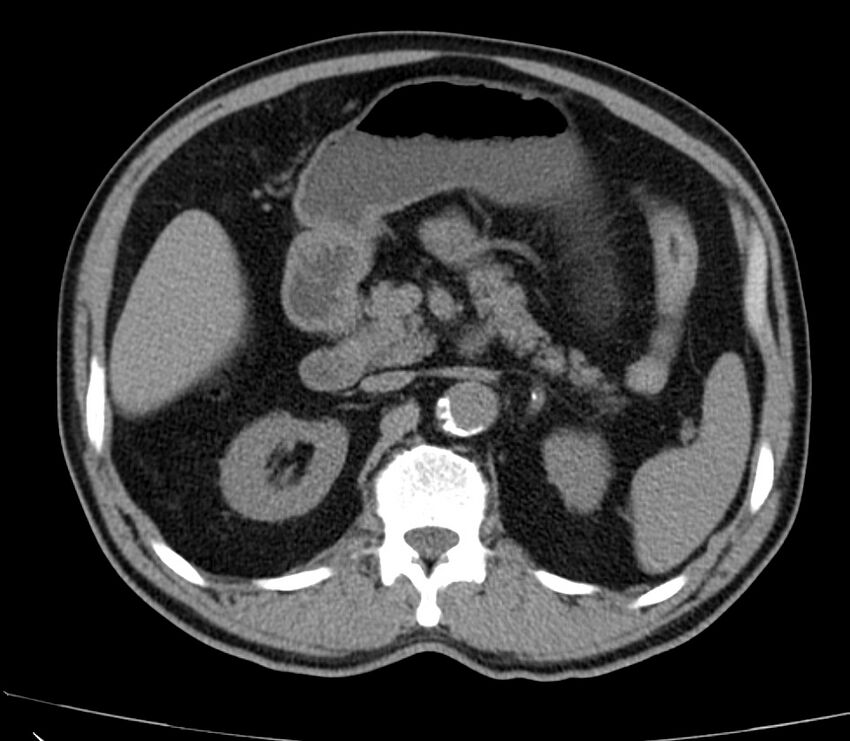 Abdominal aortic aneurysm (Radiopaedia 22421-22458 non-contrast 18).jpg