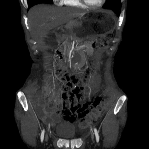 File:Abdominal aortic aneurysm (Radiopaedia 23703-23856 Coronal C+ arterial phase 3).jpg