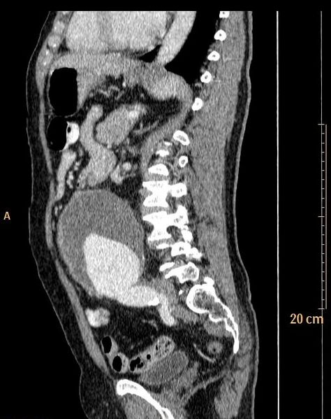 File:Abdominal aortic aneurysm (Radiopaedia 25985-26121 Sagittal C+ arterial phase 8).jpg