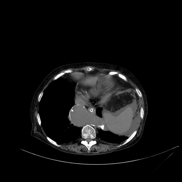 File:Abdominal aortic aneurysm - impending rupture (Radiopaedia 19233-19246 Axial non-contrast 20).jpg