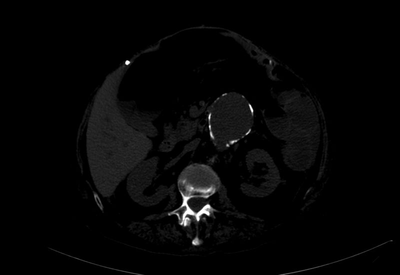 File:Abdominal aortic aneurysm - impending rupture (Radiopaedia 19233-19246 B 4).jpg