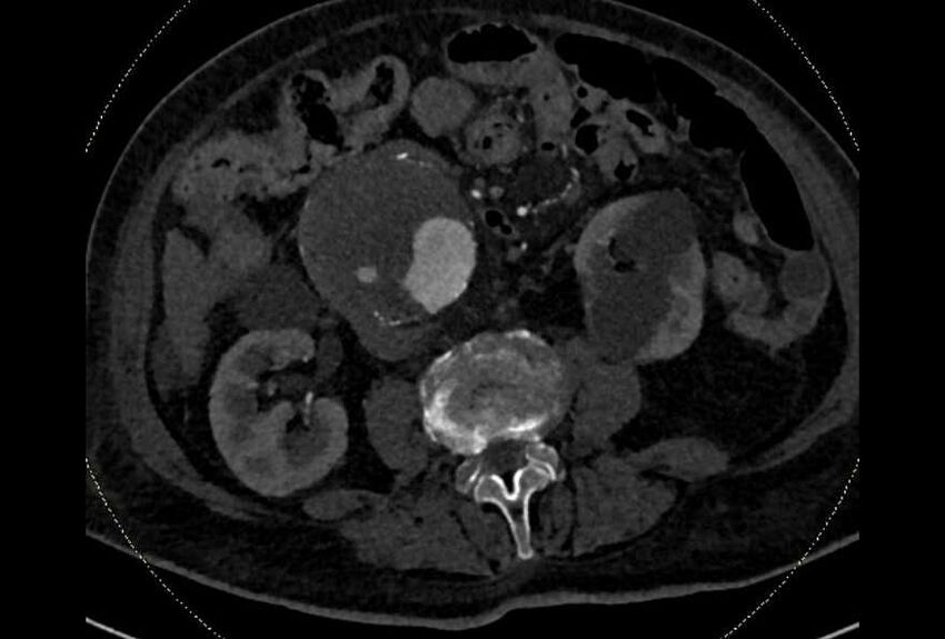 Abdominal aortic aneurysm with thrombus fissuration (Radiopaedia 73192-83919 Axial C+ arterial phase 102).jpg