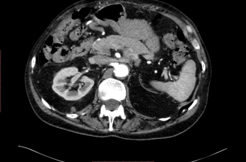 File:Abdominal aortic interposition tube graft and aneurysm thrombosis (Radiopaedia 71438-81857 Axial C+ arterial phase 31).jpg