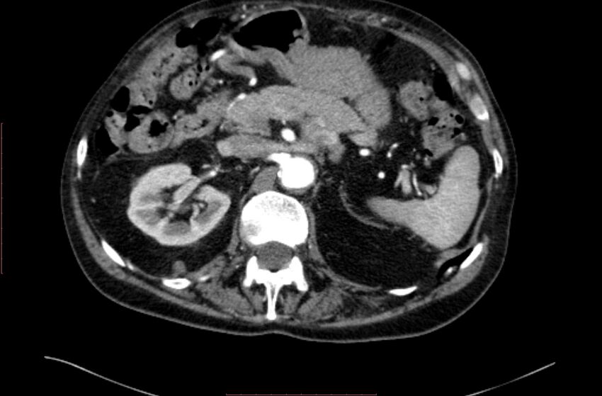 Abdominal aortic interposition tube graft and aneurysm thrombosis (Radiopaedia 71438-81857 Axial C+ arterial phase 31).jpg