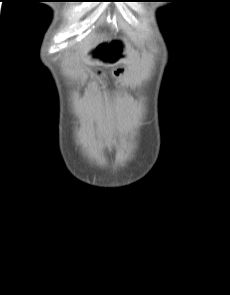 File:Abdominal desmoid tumor (Radiopaedia 41007-43740 Coronal C+ portal venous phase 5).png