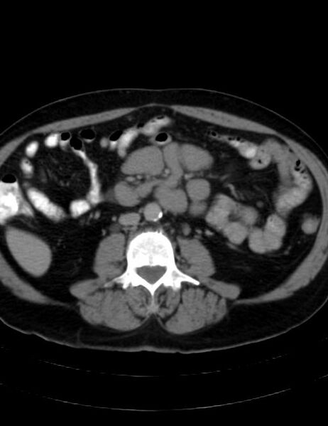 File:Abdominal lymphoma - with sandwich sign (Radiopaedia 53486-59492 Axial C+ portal venous phase 27).jpg