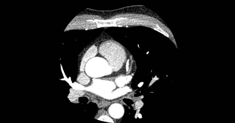 File:Aberrant left main coronary artery (ALMCA) arising from the right sinus with interarterial course (Radiopaedia 63251-71814 Axial C+ arterial phase 50).JPG