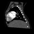 Aberrant left pulmonary artery (pulmonary sling) (Radiopaedia 42323-45435 Sagittal C+ arterial phase 13).jpg