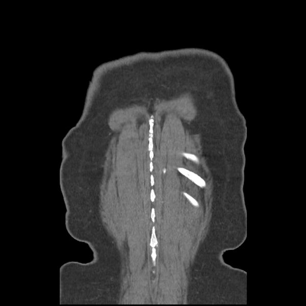 File:Aberrant right subclavian and left vertebral arteries (Radiopaedia 43467-46847 Coronal C+ portal venous phase 84).jpg