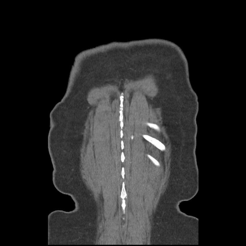 Aberrant right subclavian and left vertebral arteries (Radiopaedia 43467-46847 Coronal C+ portal venous phase 84).jpg
