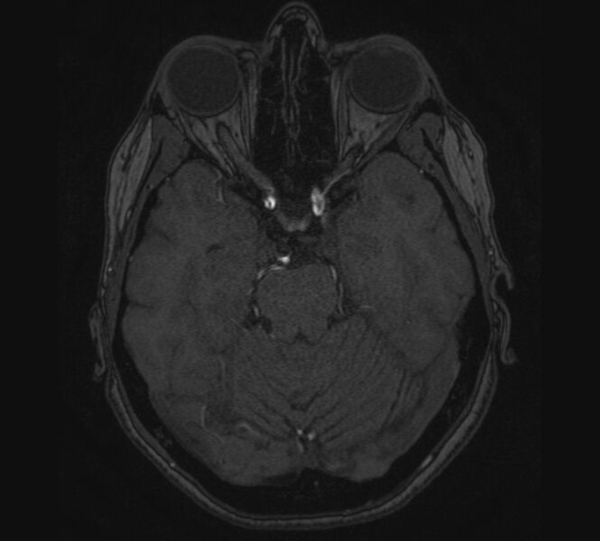 File:Accessory middle cerebral artery and ICA aneurysm (Radiopaedia 22656-22674 MRA 35).jpg
