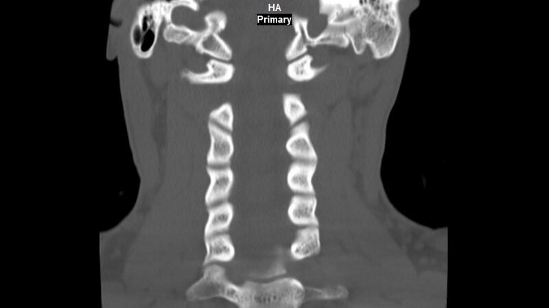 File:Accessory ossicle of the anterior arch of C1 vertebra (Radiopaedia 58149-65211 Coronal bone window 9).jpg