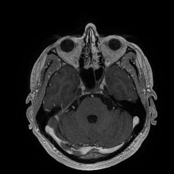 File:Acoustic schwannoma - intracanalicular (Radiopaedia 37247-39024 Axial T1 C+ 78).jpg