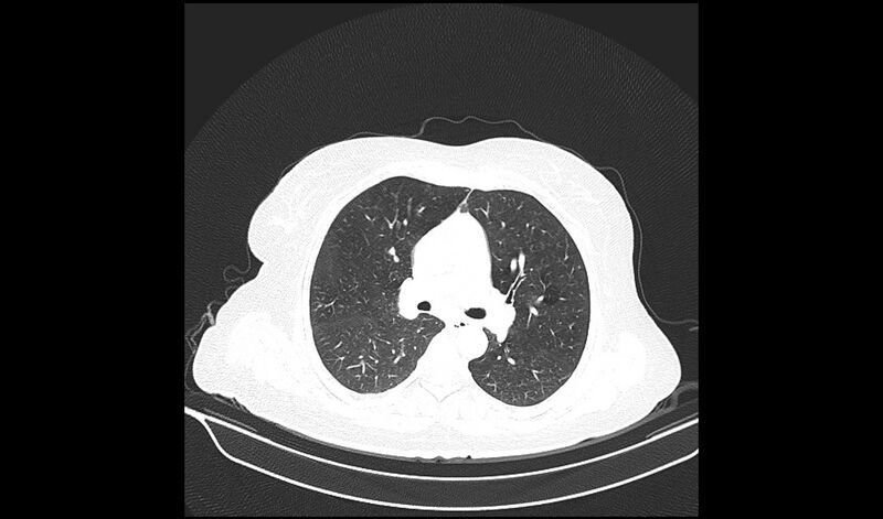 File:Acquired tracheo-esophageal fistula (Radiopaedia 51356-57103 Axial lung window 20).jpg