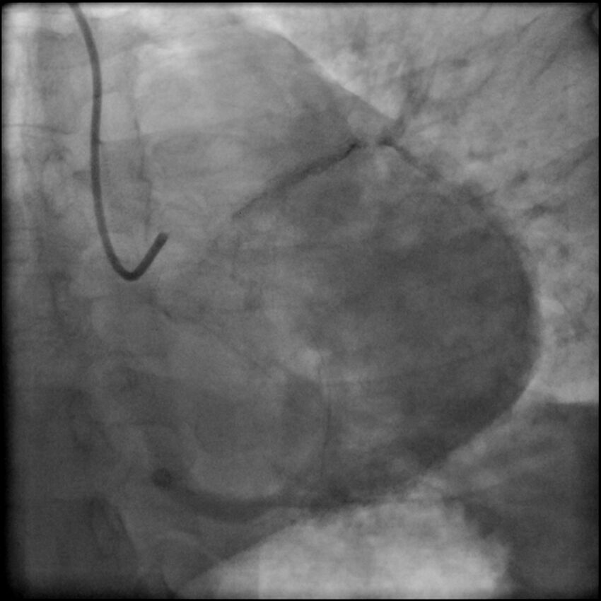 Acute anteroseptal myocardial infarction (Radiopaedia 68409-77946 LAO caudal (spider view) LAD and CX 83).jpg