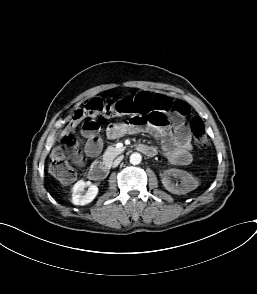 Acute arterial mesenteric ischemia (Radiopaedia 78238-90828 Axial C+ portal venous phase 58).jpg