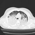 Acute aspiration pneumonitis (Radiopaedia 33605-34703 Axial lung window 35).jpg