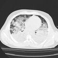 Acute aspiration pneumonitis (Radiopaedia 33605-34703 Axial lung window 54).jpg